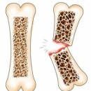 Что такое остеопороз