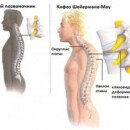 Кифоз — болезнь, которая может погубить всех!